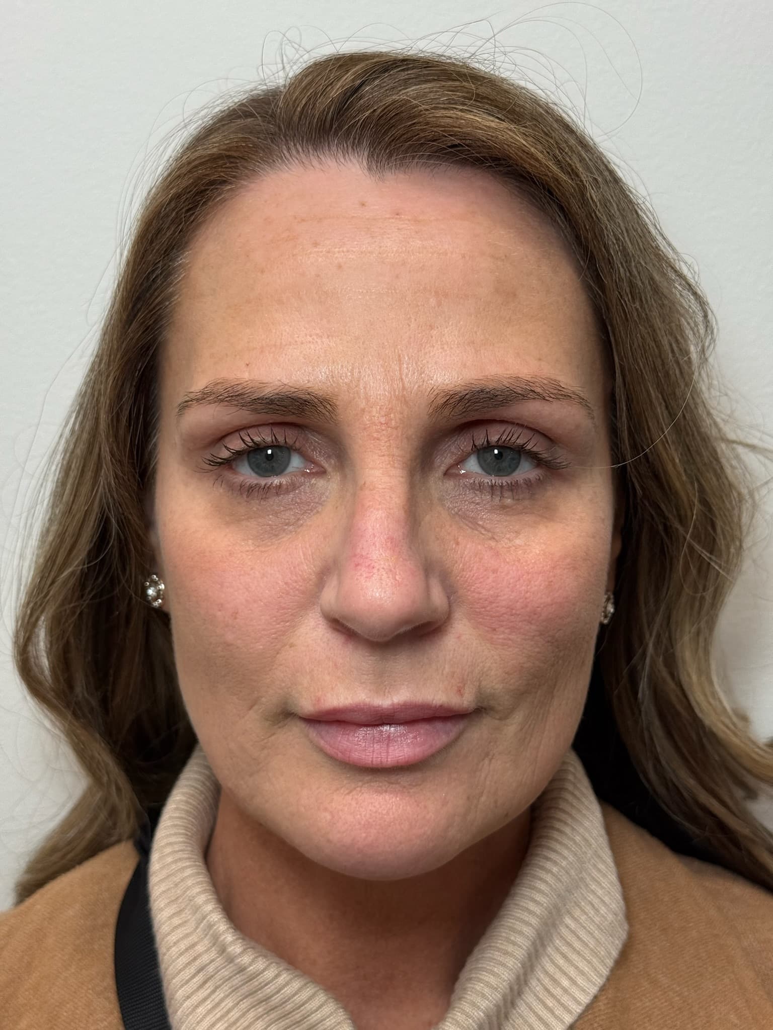 After Image: Facial Balancing - front