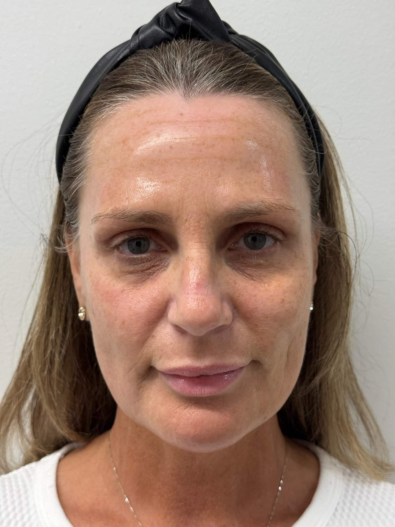 Before Image: Facial Balancing - front