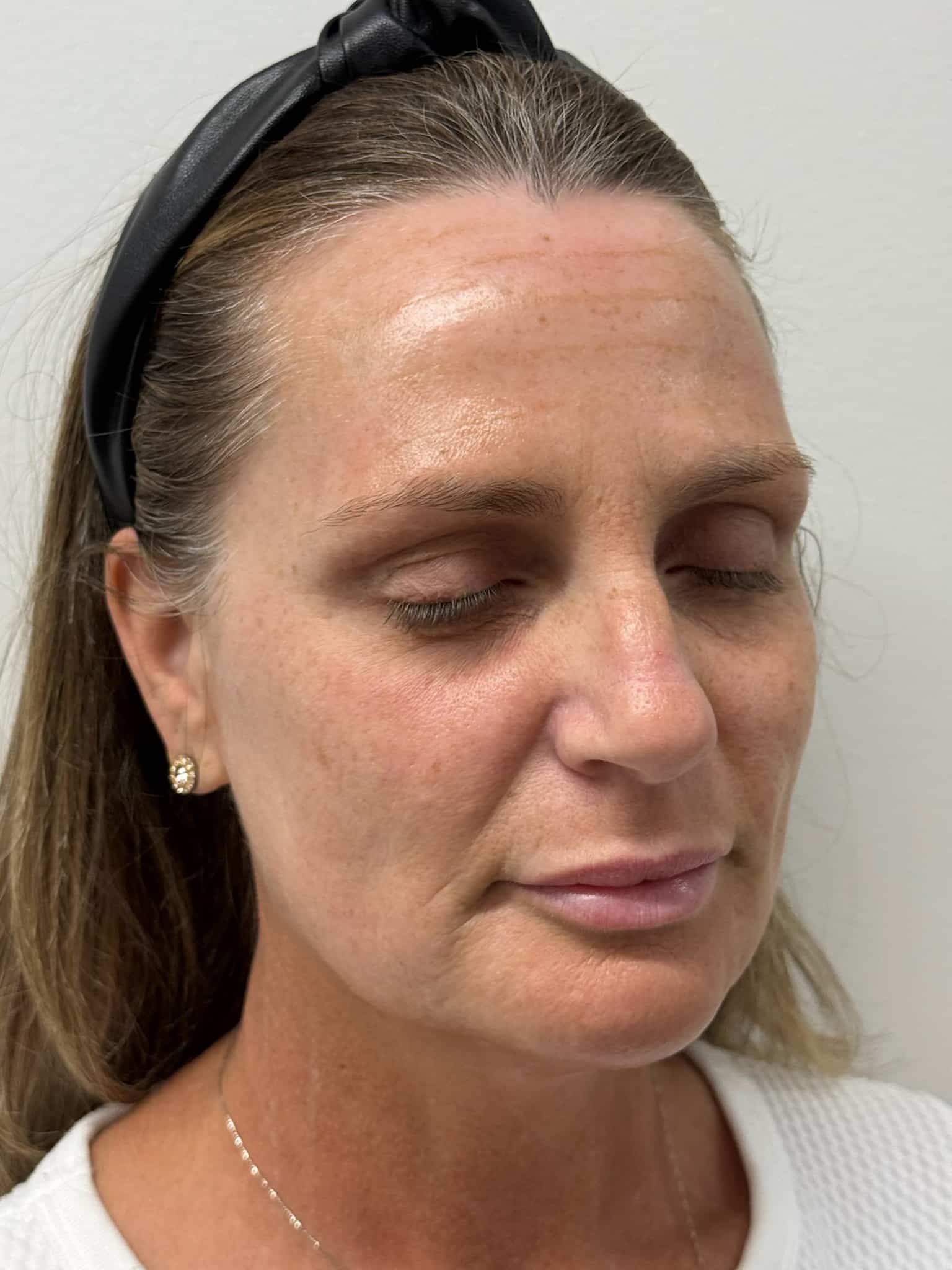 Before Image: Facial Balancing - right-front-oblique