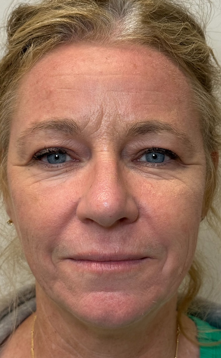 After Image: Full Facial Balancing - front