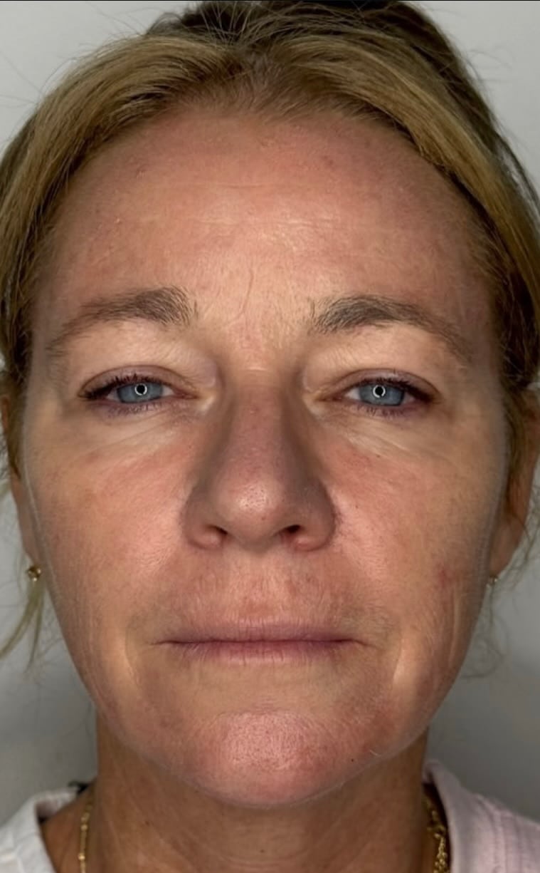 Before Image: Full Facial Balancing - front