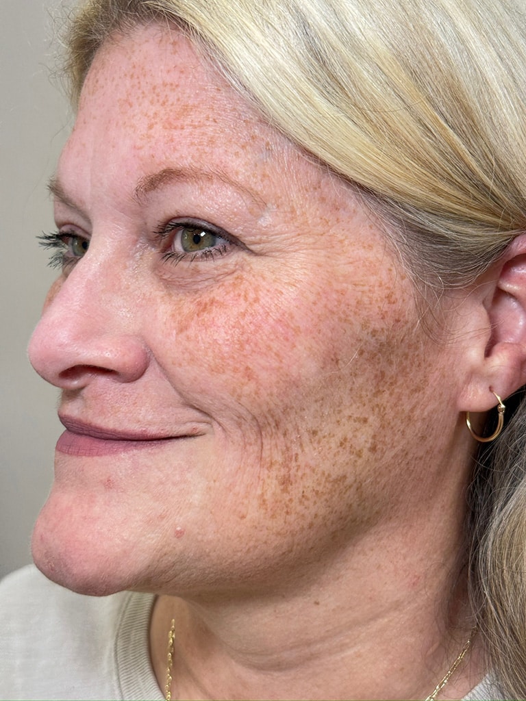 After Image: Sculptra - left-front-oblique