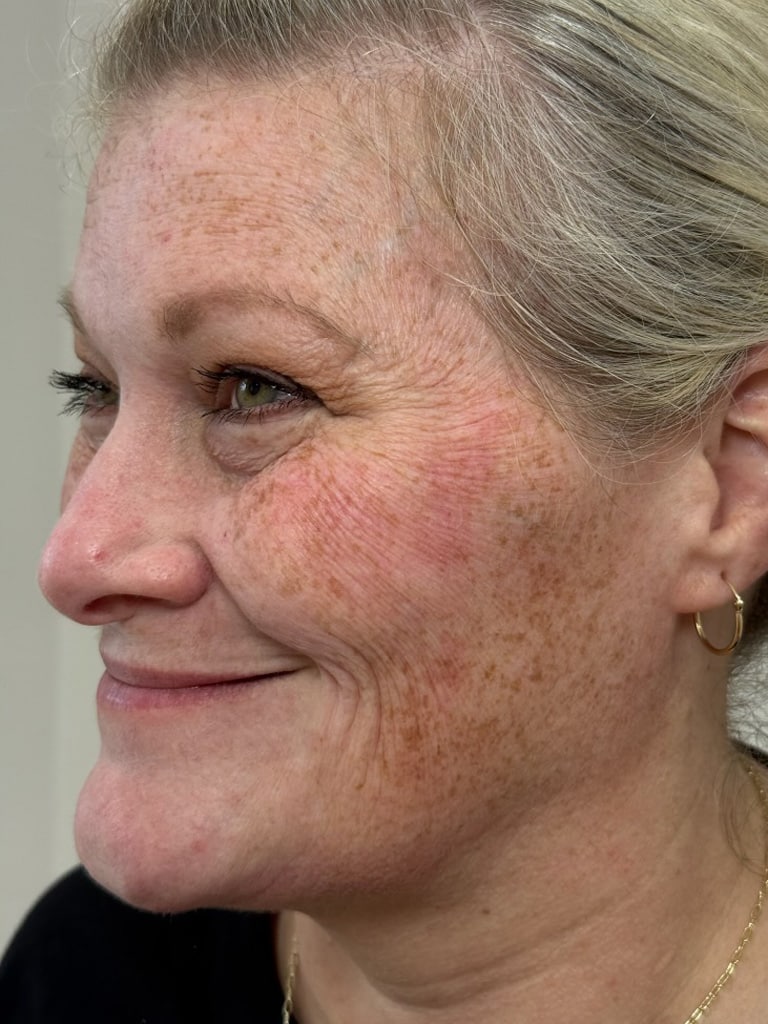 Before Image: Sculptra - left-front-oblique