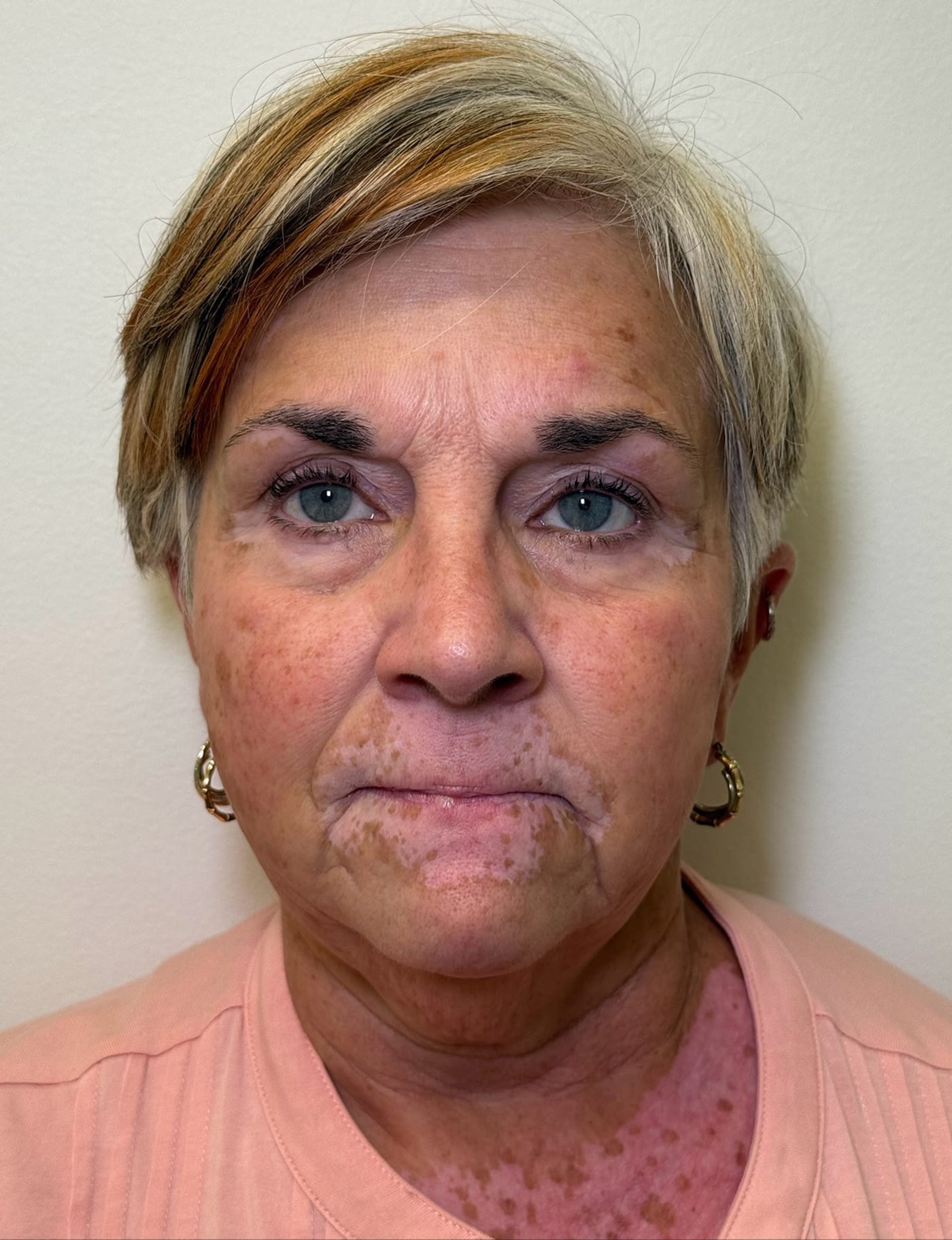 After Image: Ultherapy - front