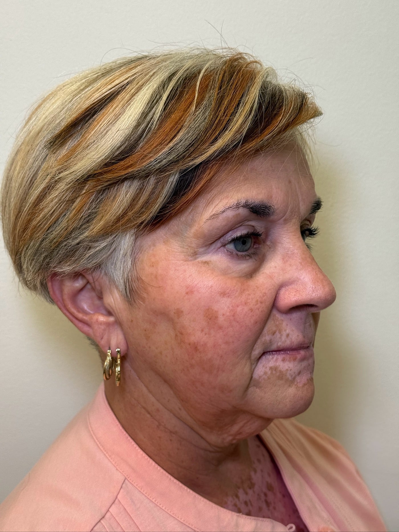 After Image: Ultherapy - right-front-oblique