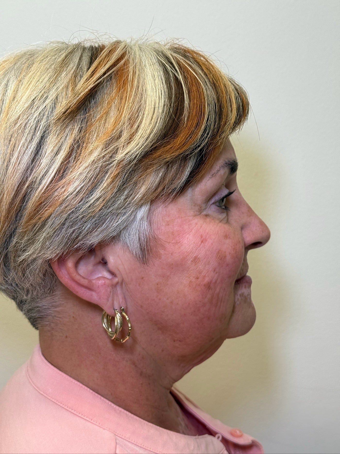 After Image: Ultherapy - right-side