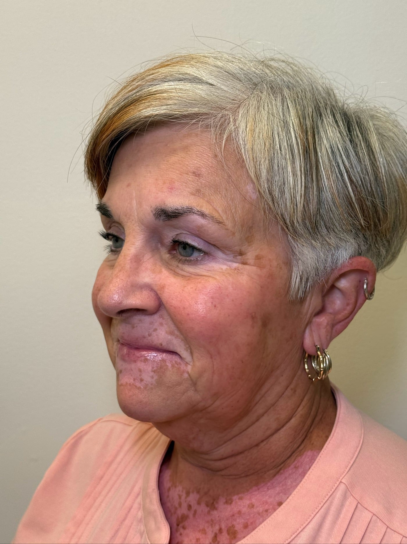 After Image: Ultherapy - left-side