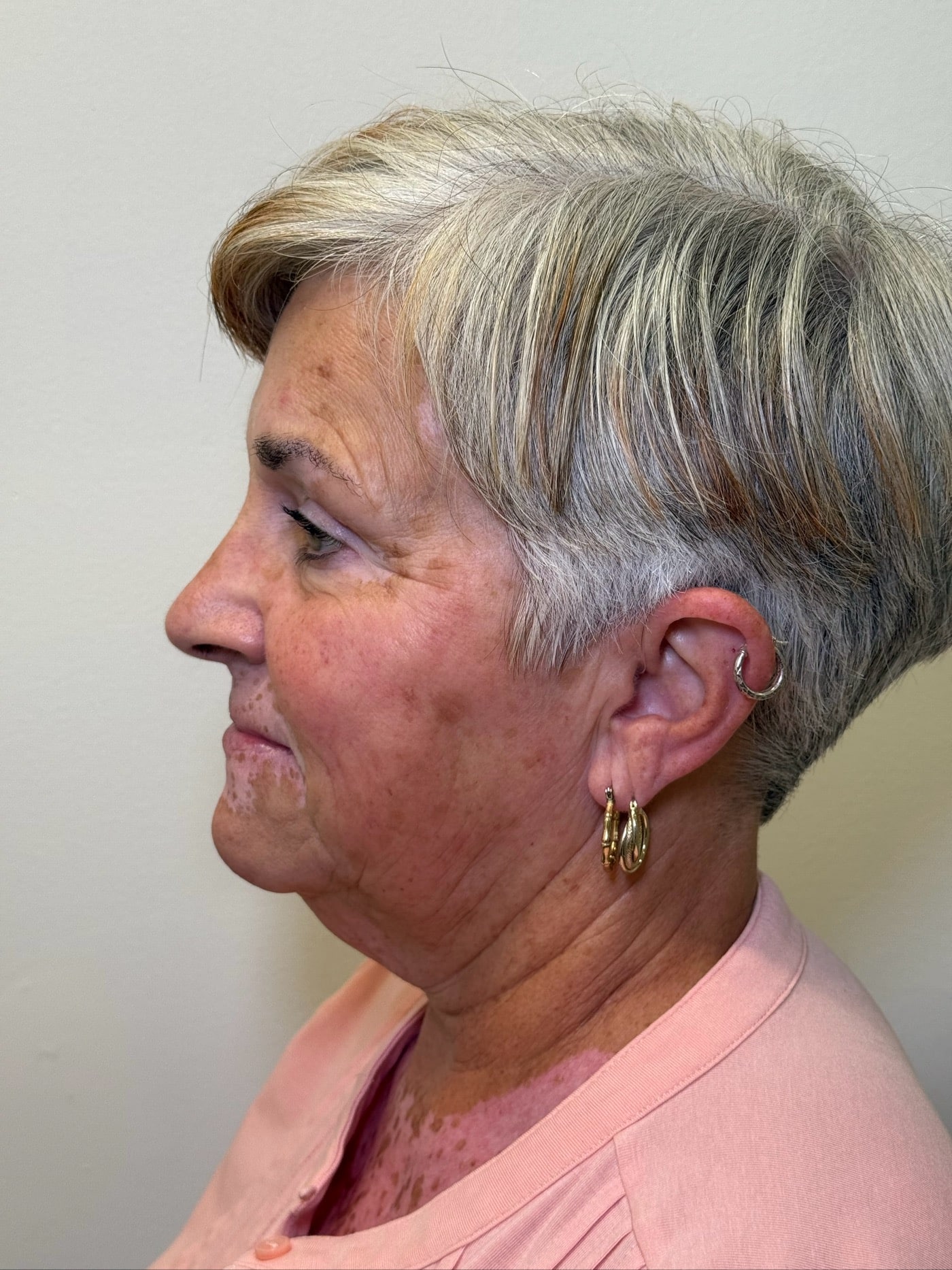 After Image: Ultherapy - left-side