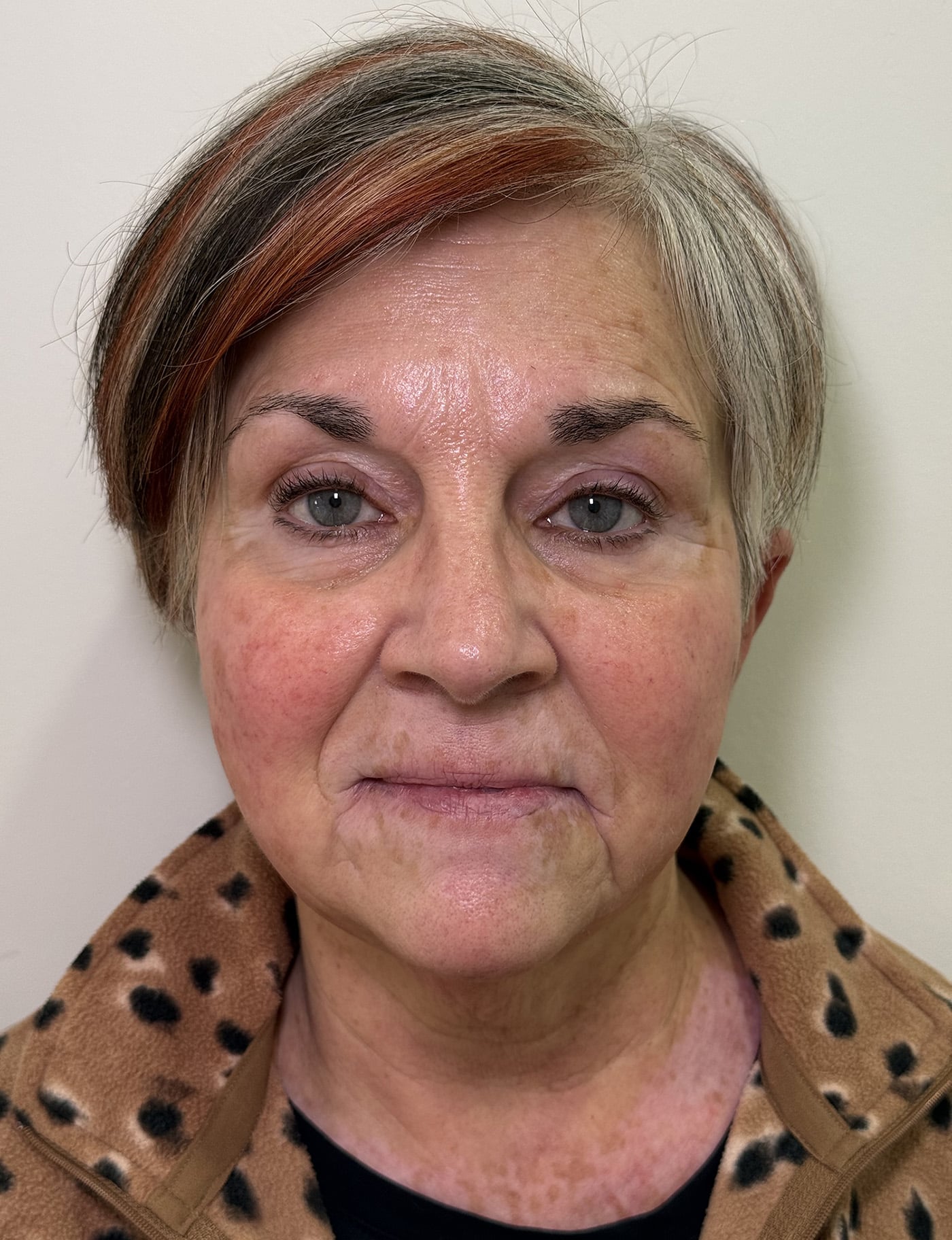 Before Image: Ultherapy - front