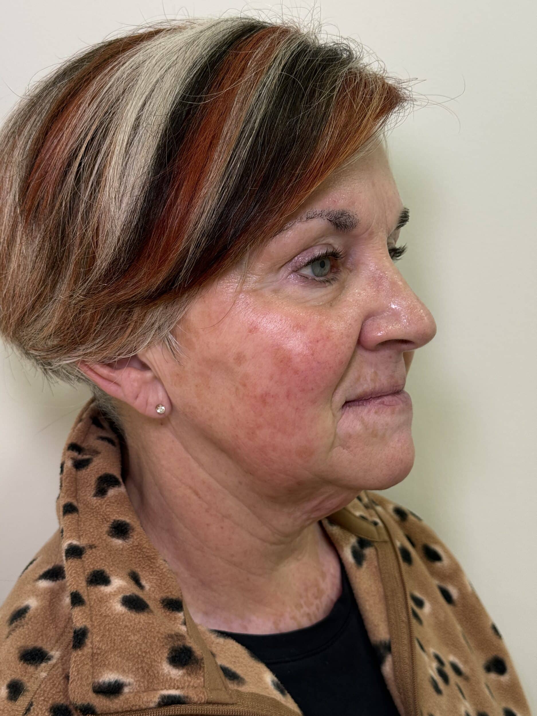 Before Image: Ultherapy - right-front-oblique