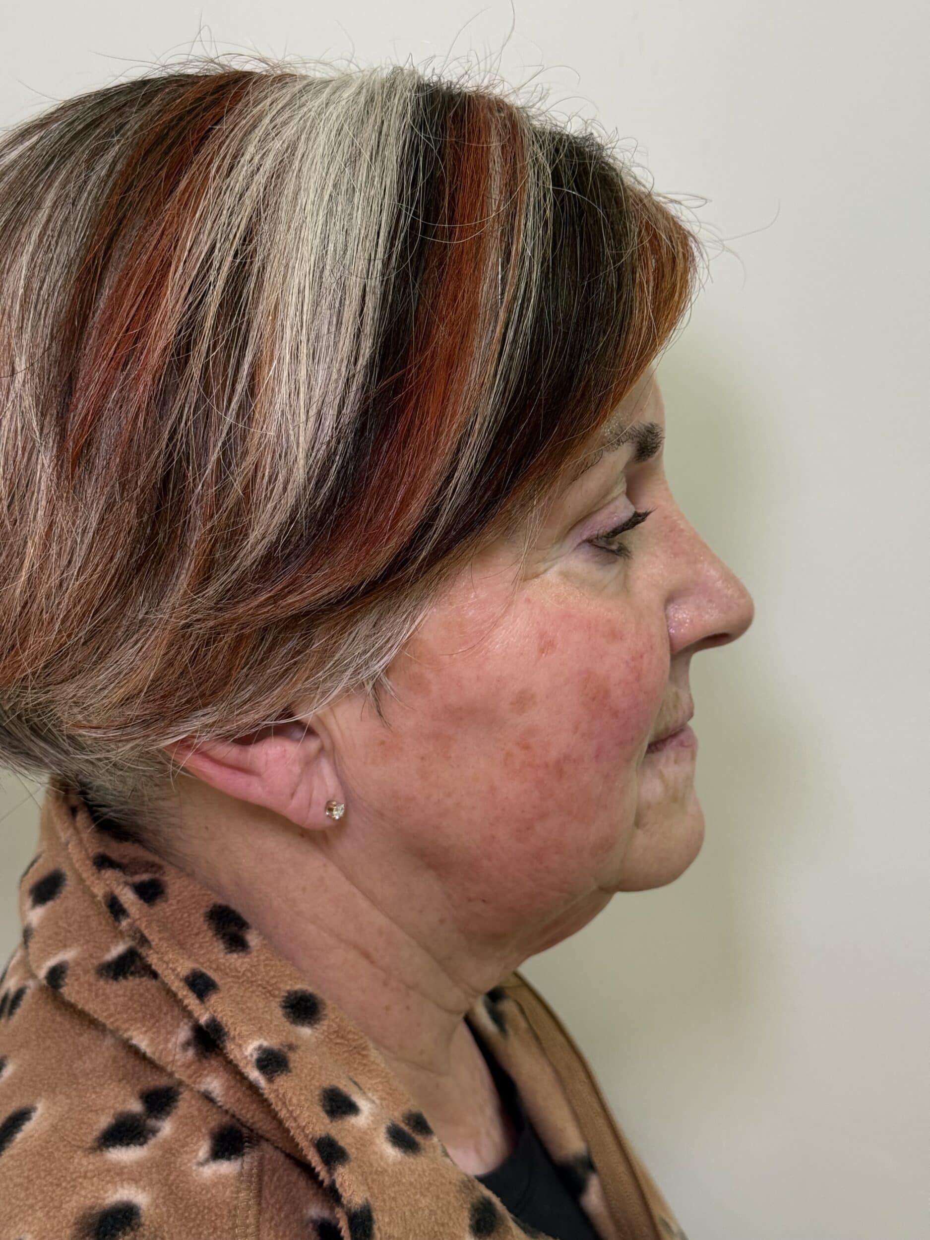 Before Image: Ultherapy - right-side