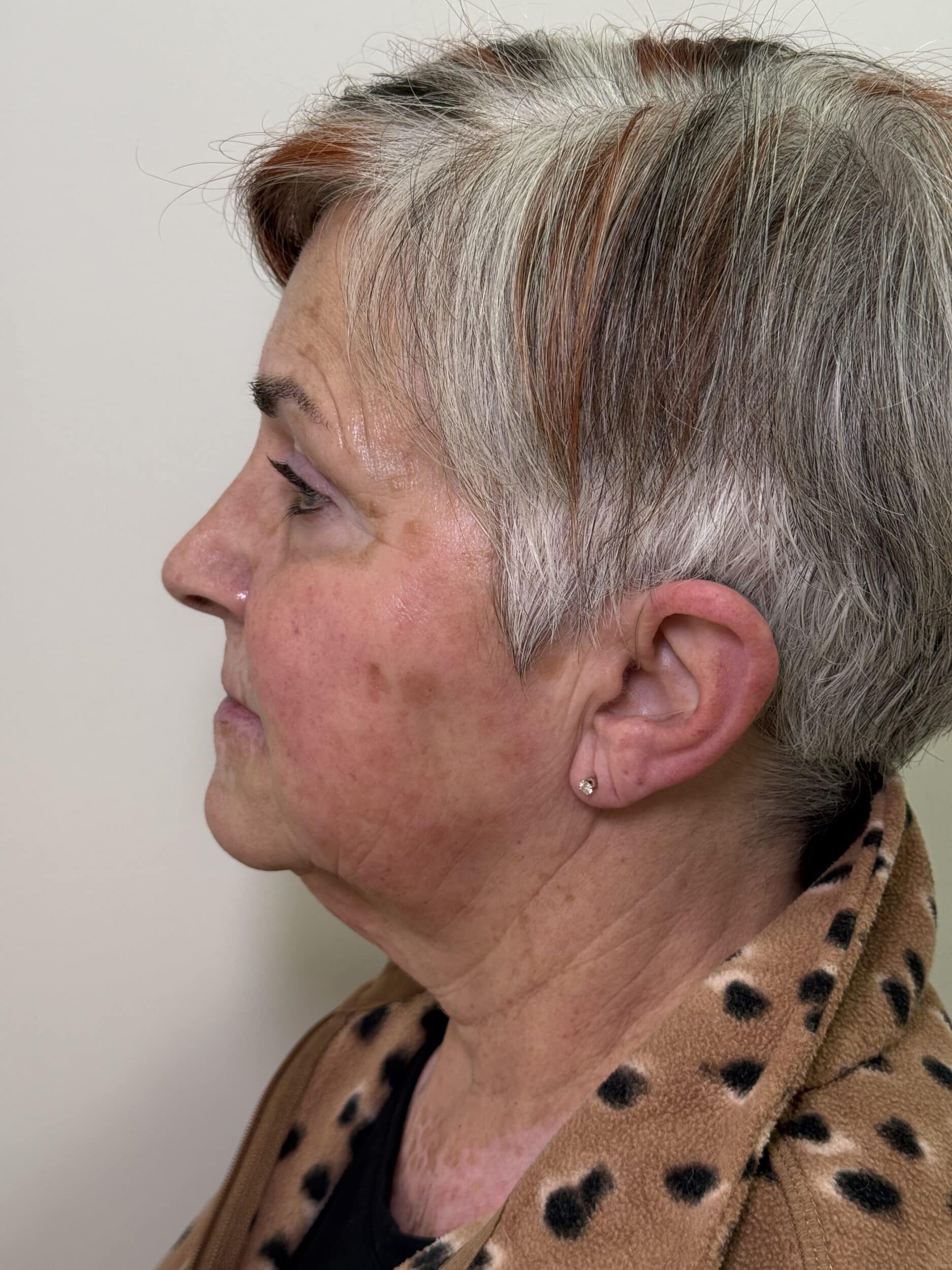Before Image: Ultherapy - left-side