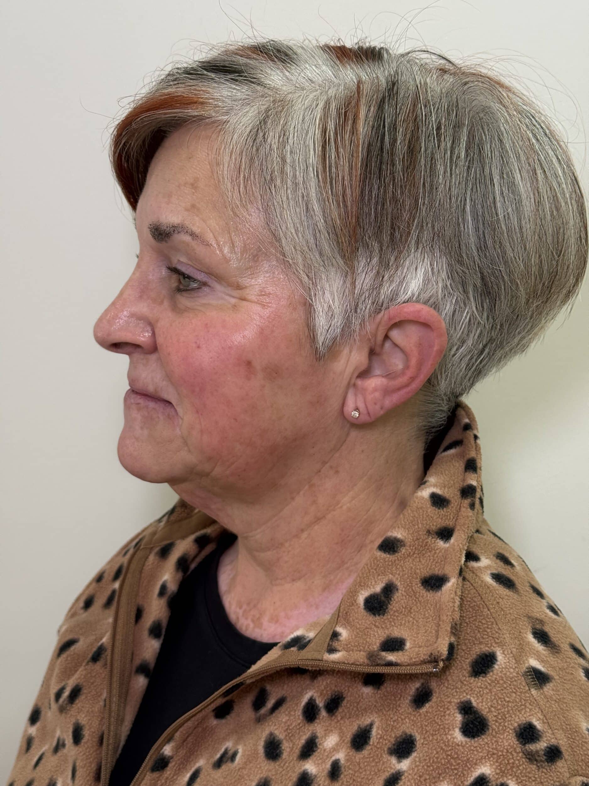 Before Image: Ultherapy - left-side