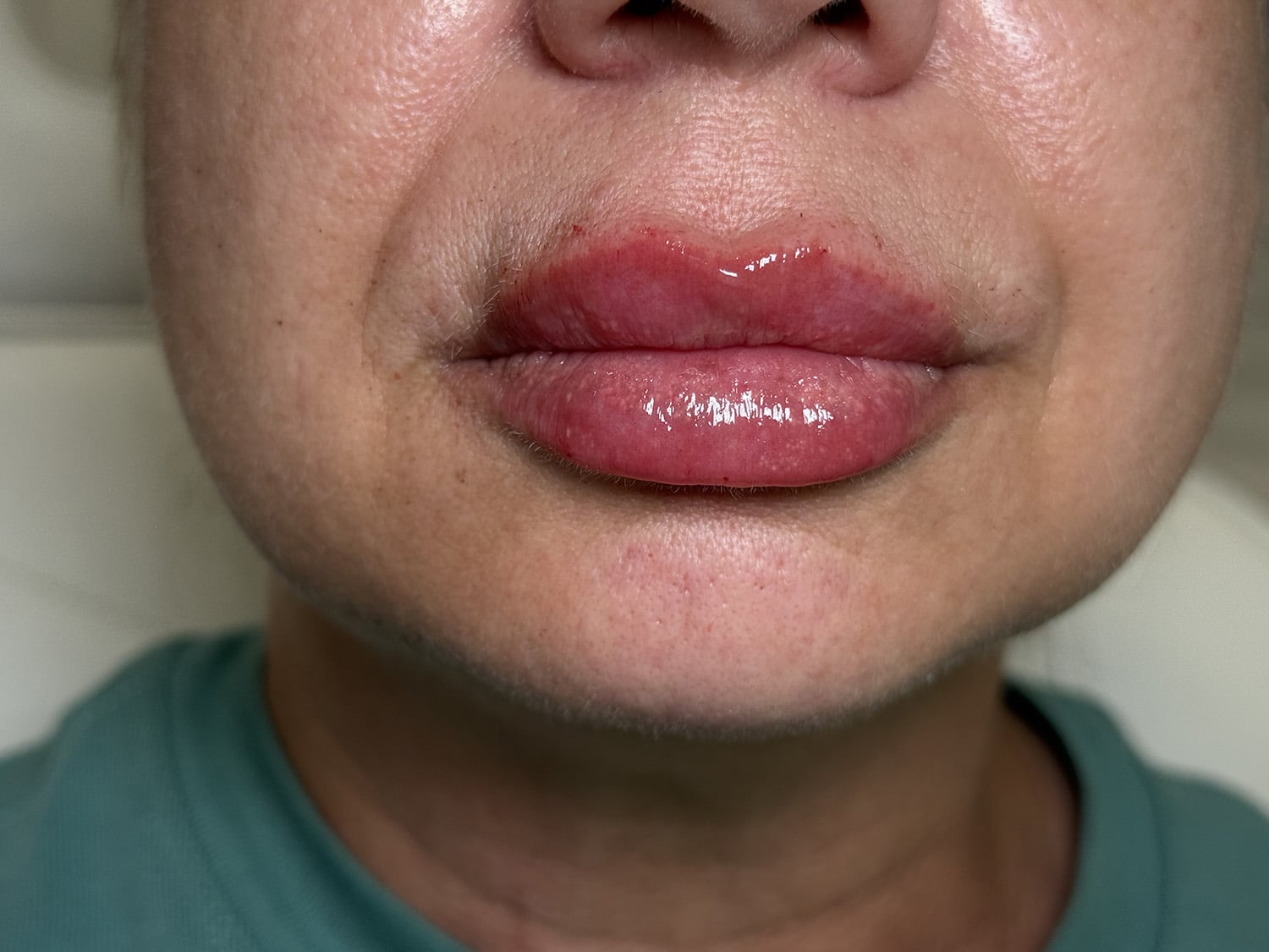 After Image: Lip Filler - front
