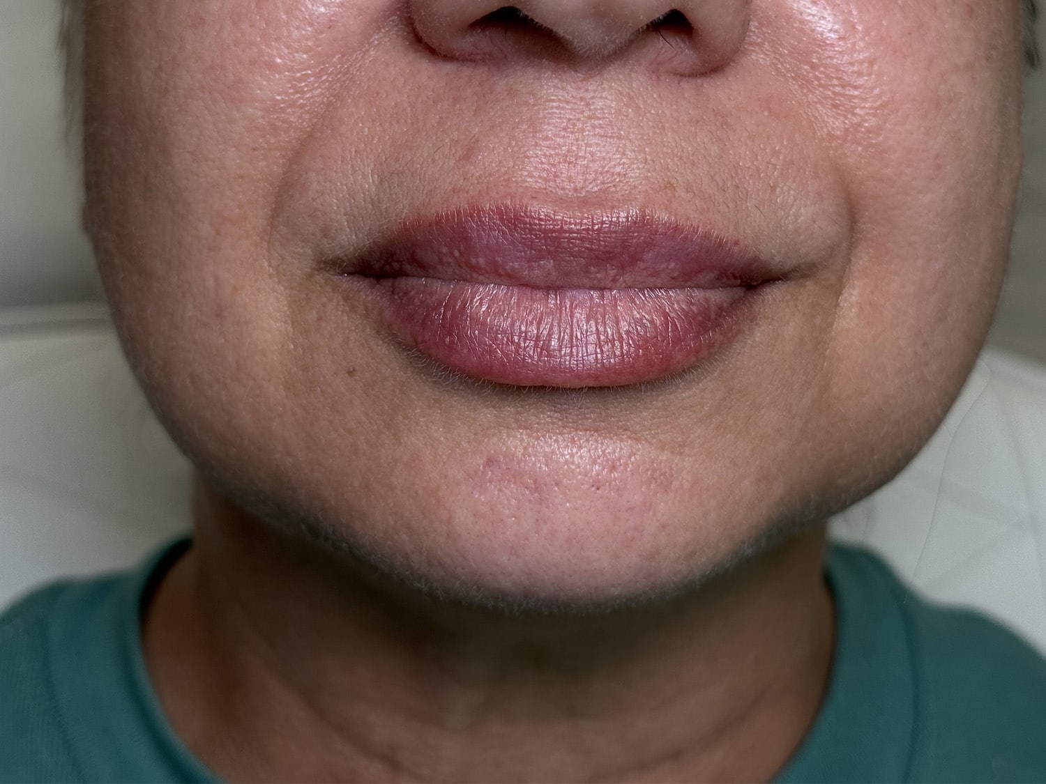 Before Image: Lip Filler - front