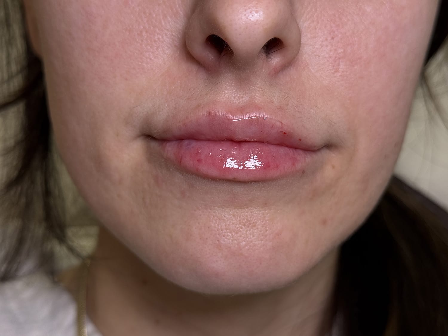 After Image: Lip Filler - front