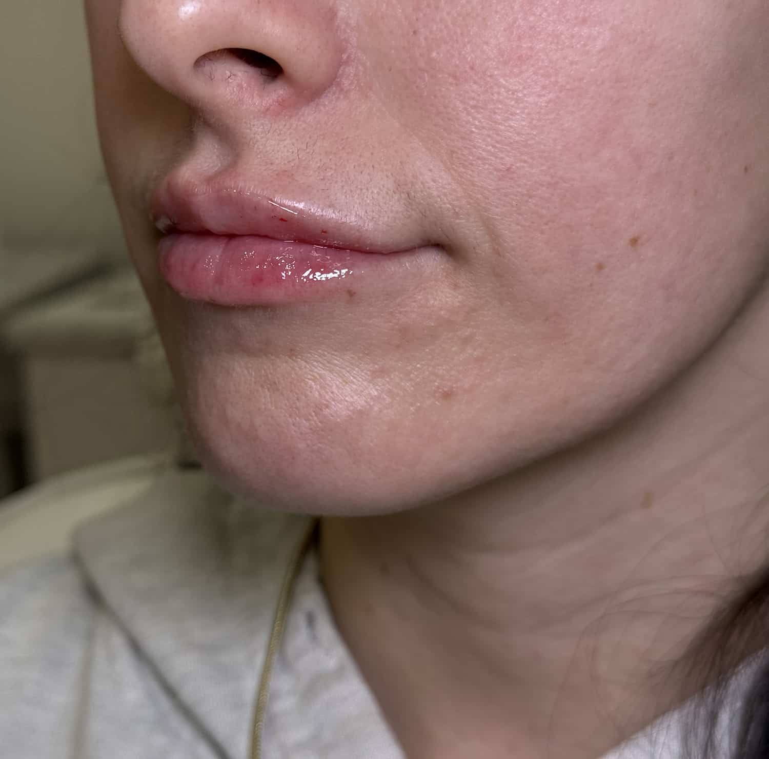 After Image: Lip Filler - left-front-oblique