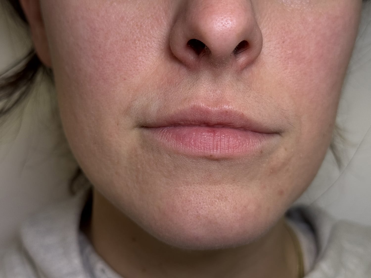 Before Image: Lip Filler - front
