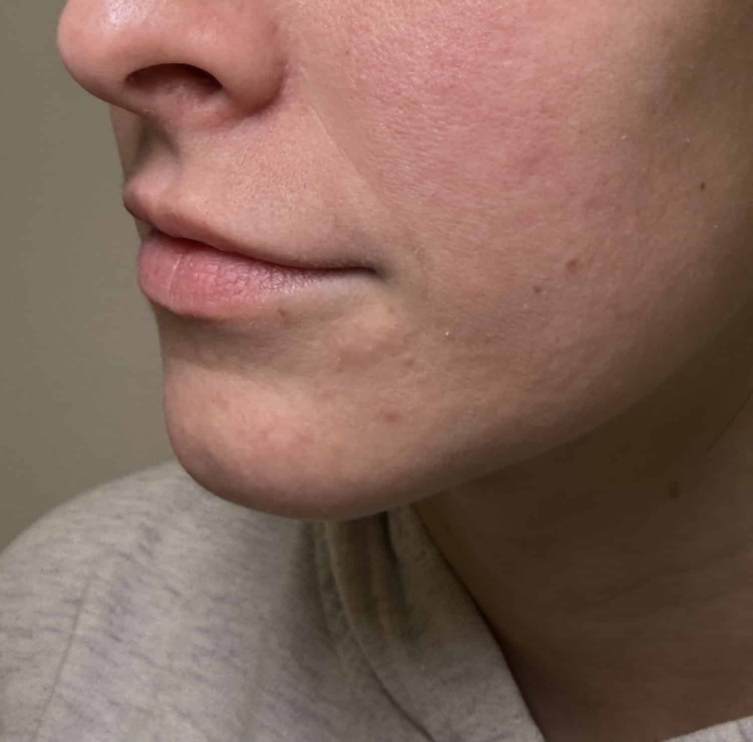 Before Image: Lip Filler - left-front-oblique