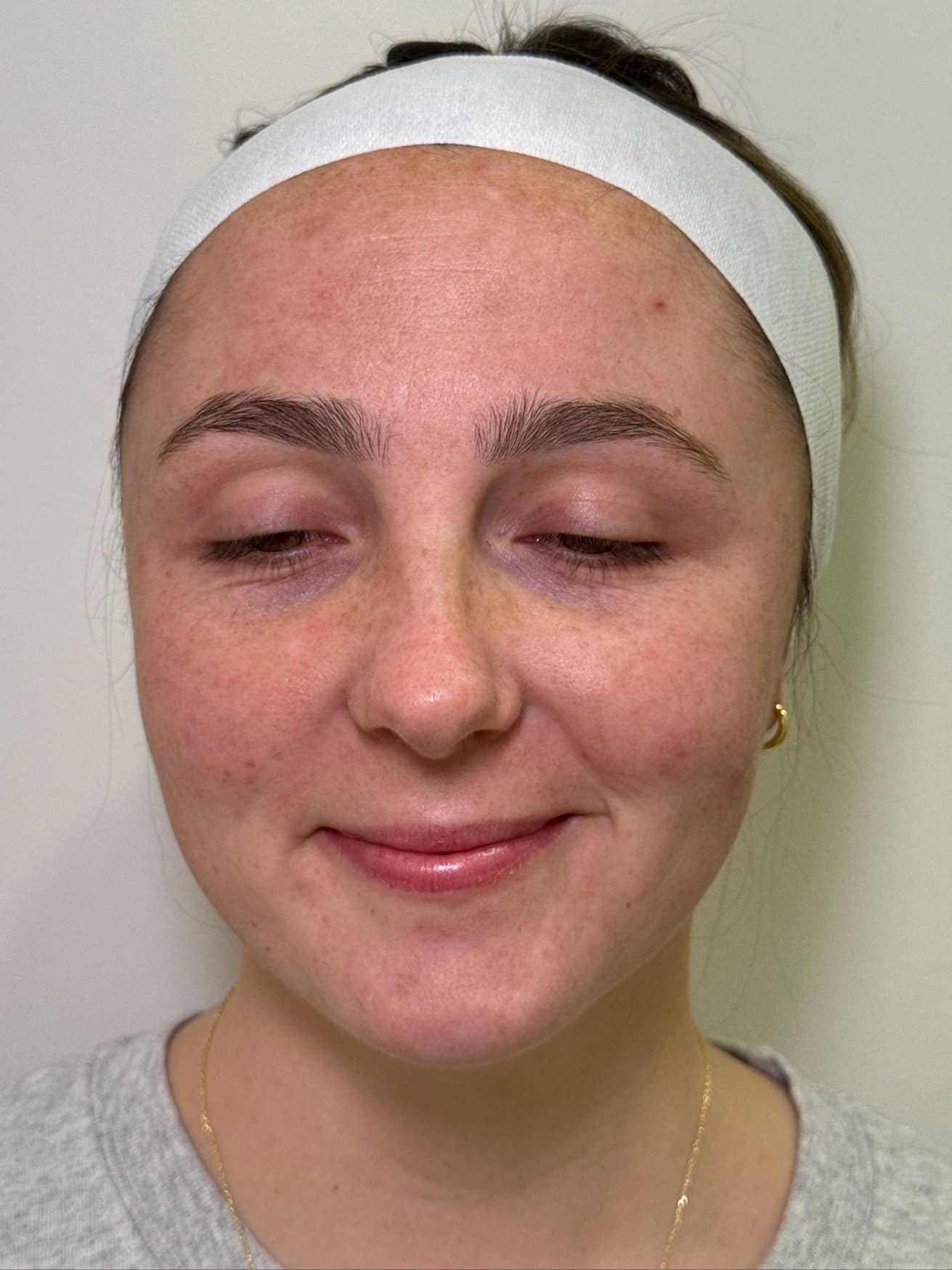 After Image: IPL for Hyperpigmentation - front