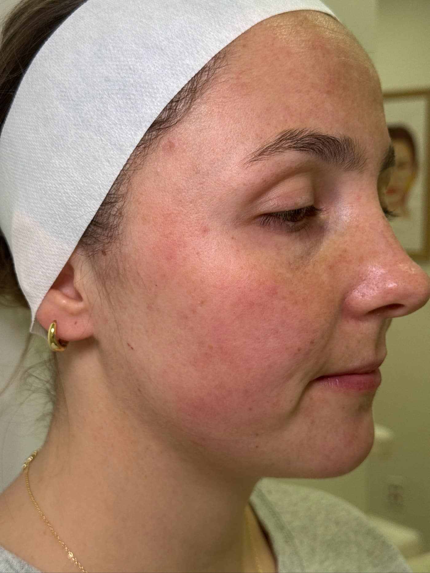 After Image: IPL for Hyperpigmentation - right-side