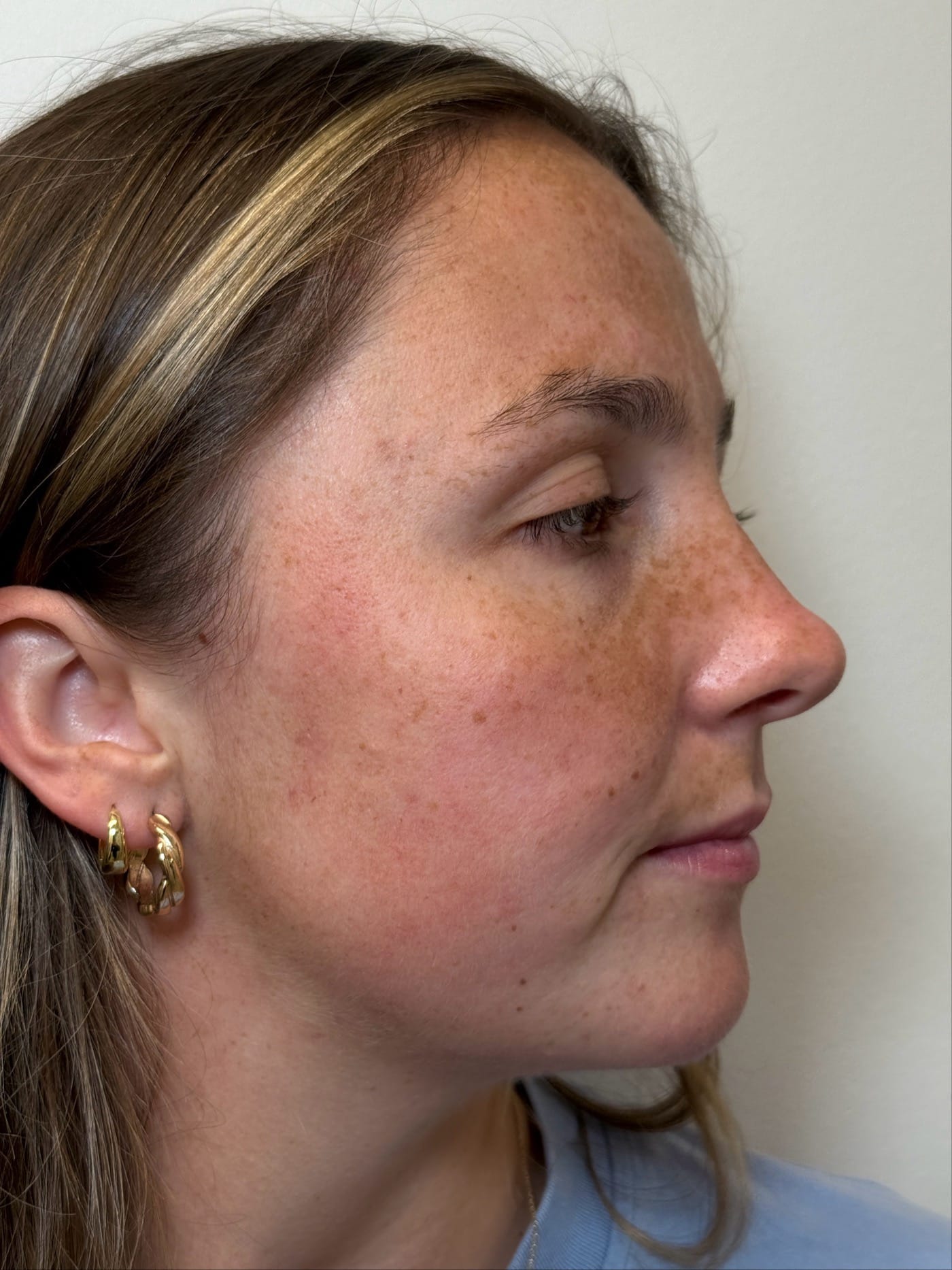 Before Image: IPL for Hyperpigmentation - right-side