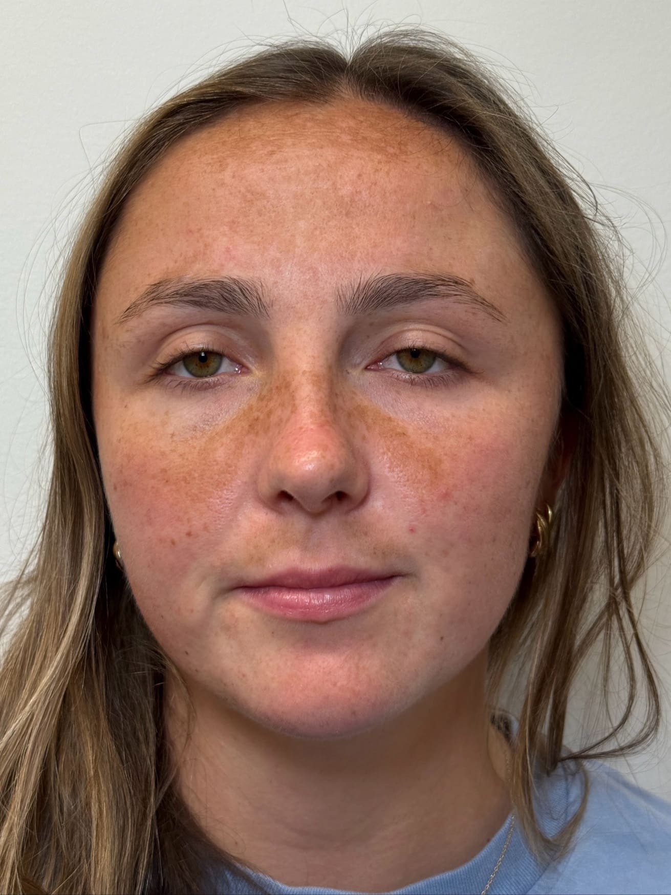 Before Image: IPL for Hyperpigmentation - front