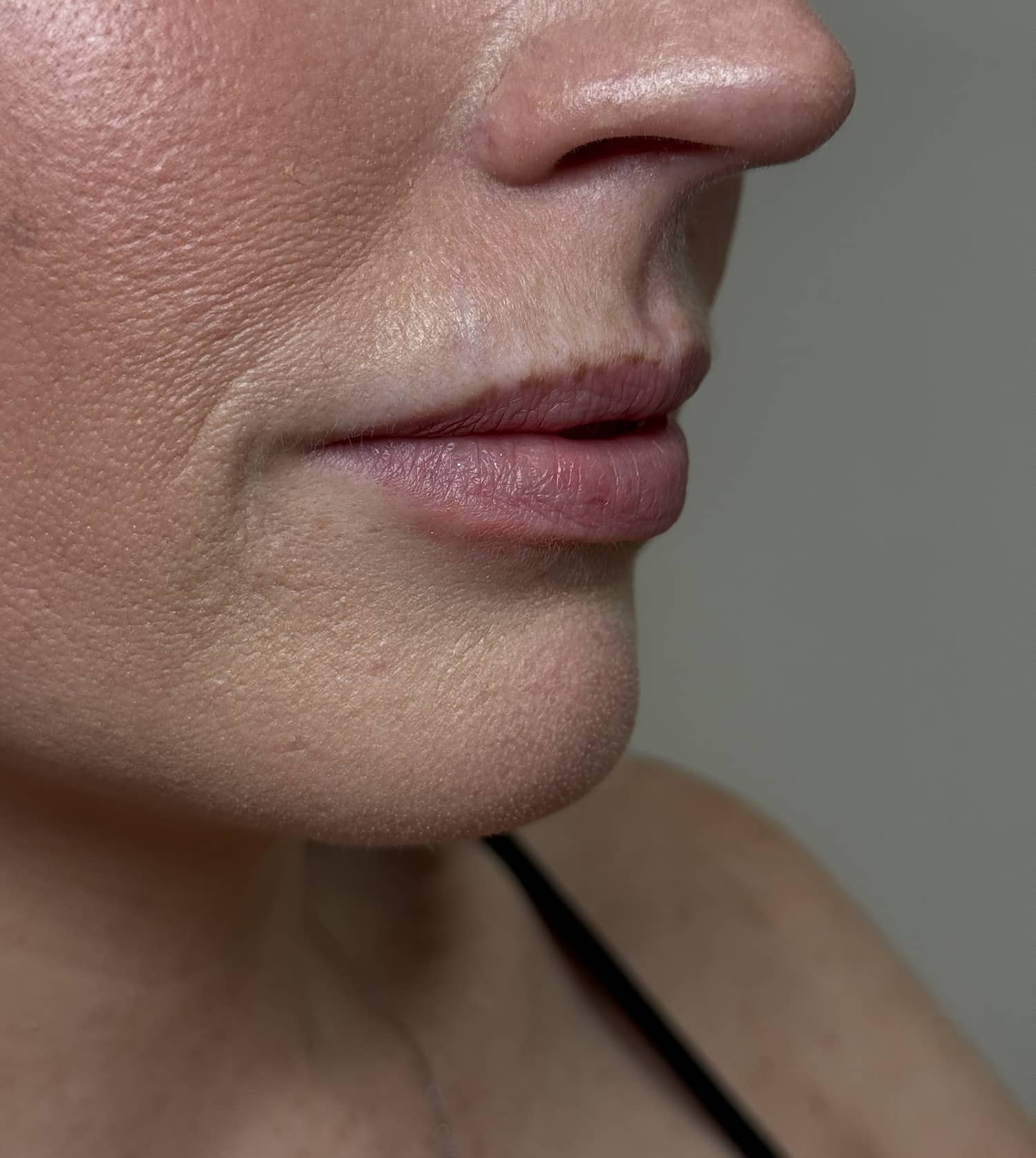 Before Image: Lip Filler - right-front-oblique