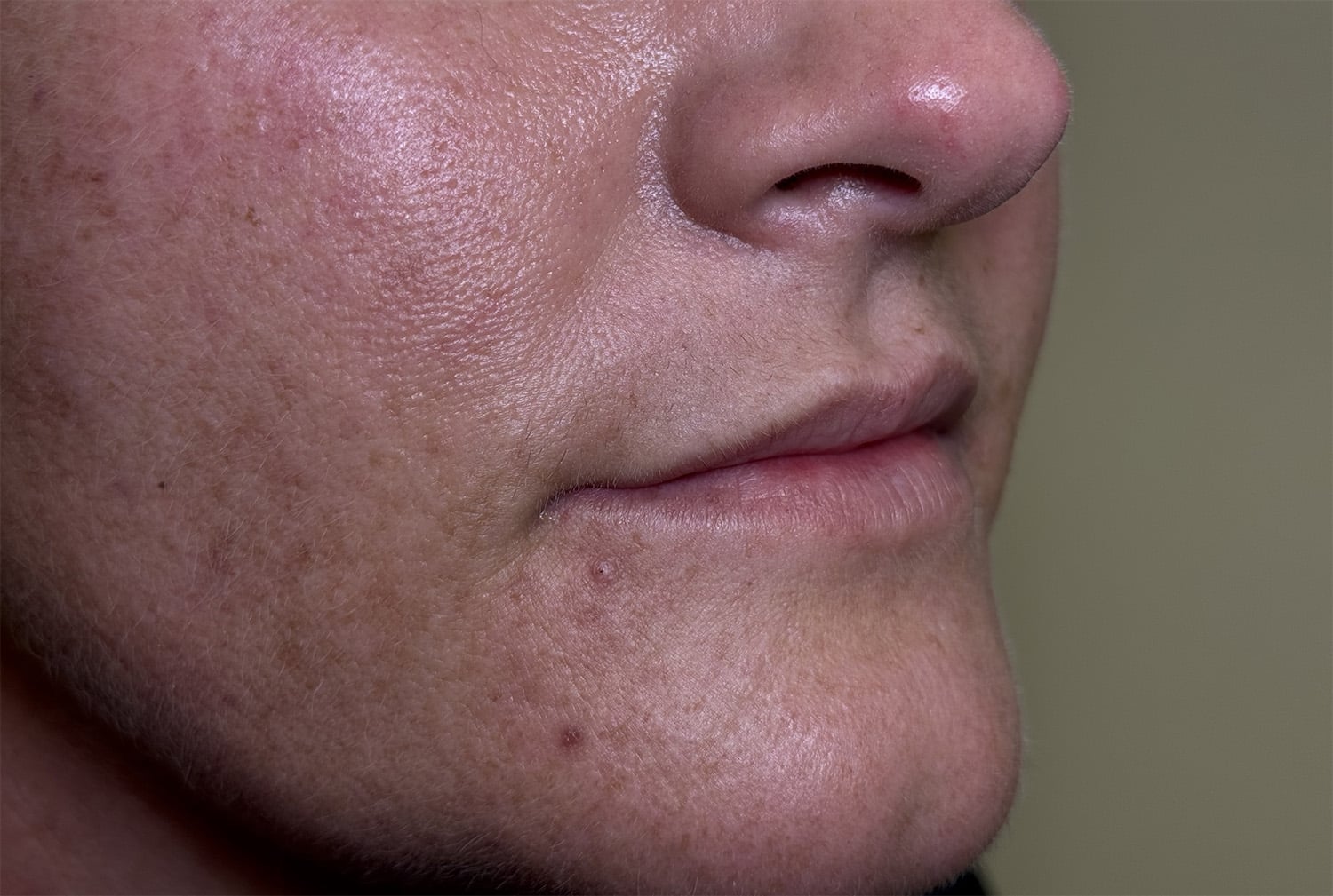 Before Image: Lip Filler - right-front-oblique