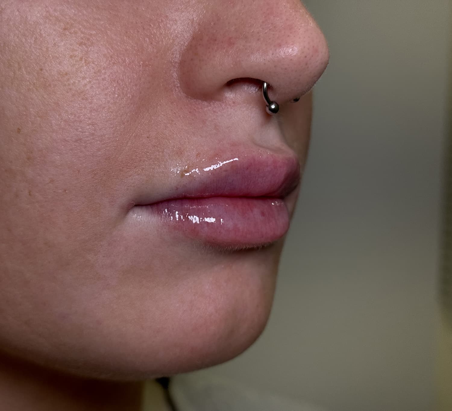 After Image: Lip Filler - right-front-oblique