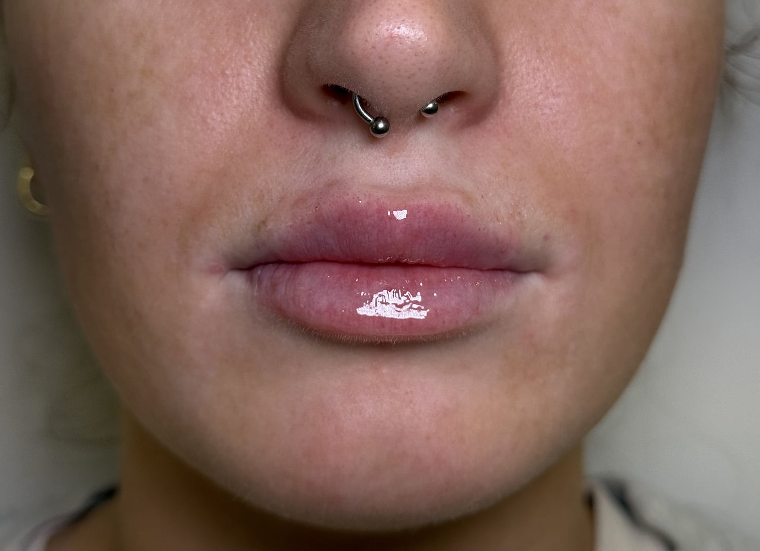 After Image: Lip Filler - front