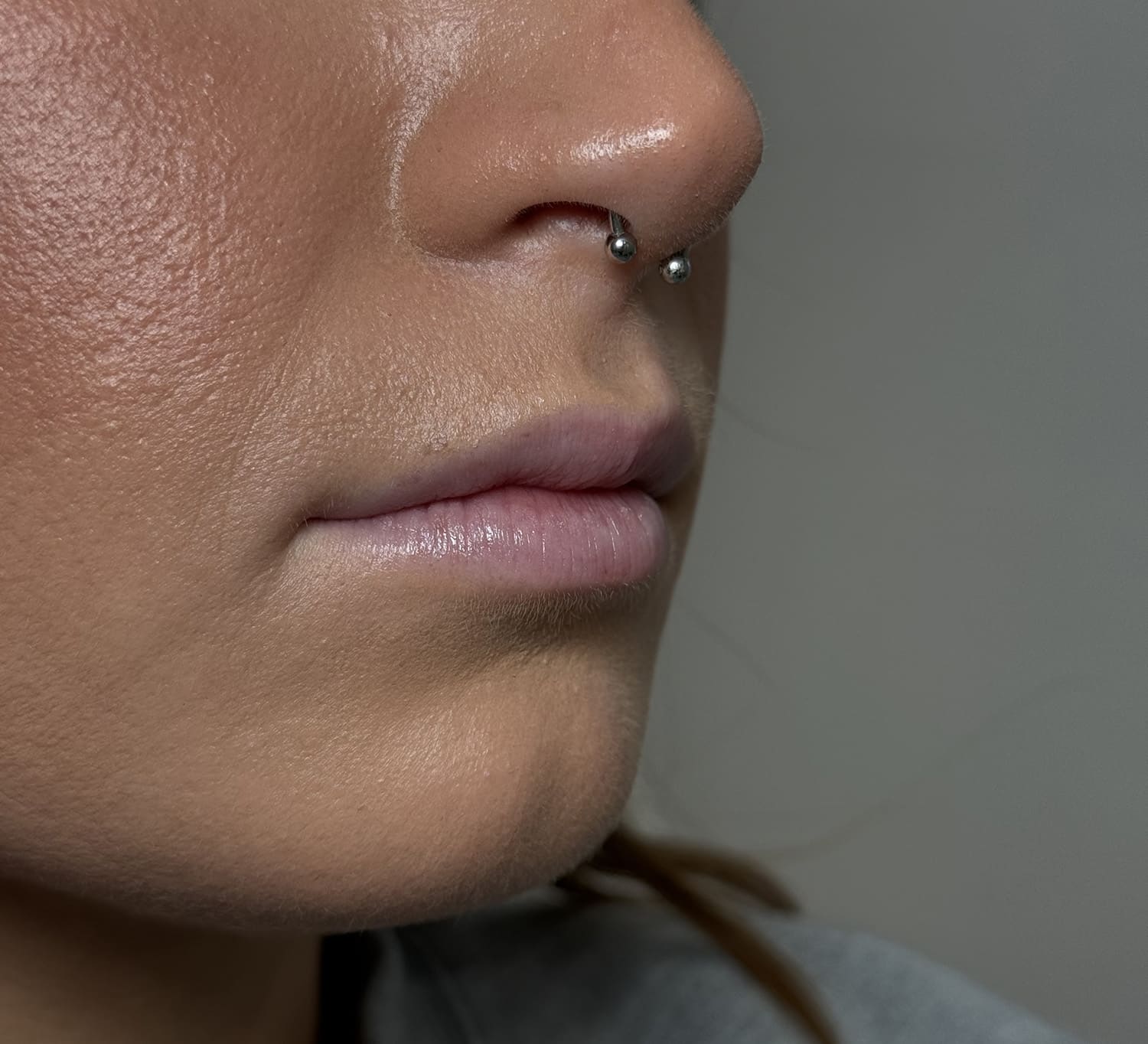 Before Image: Lip Filler - right-front-oblique