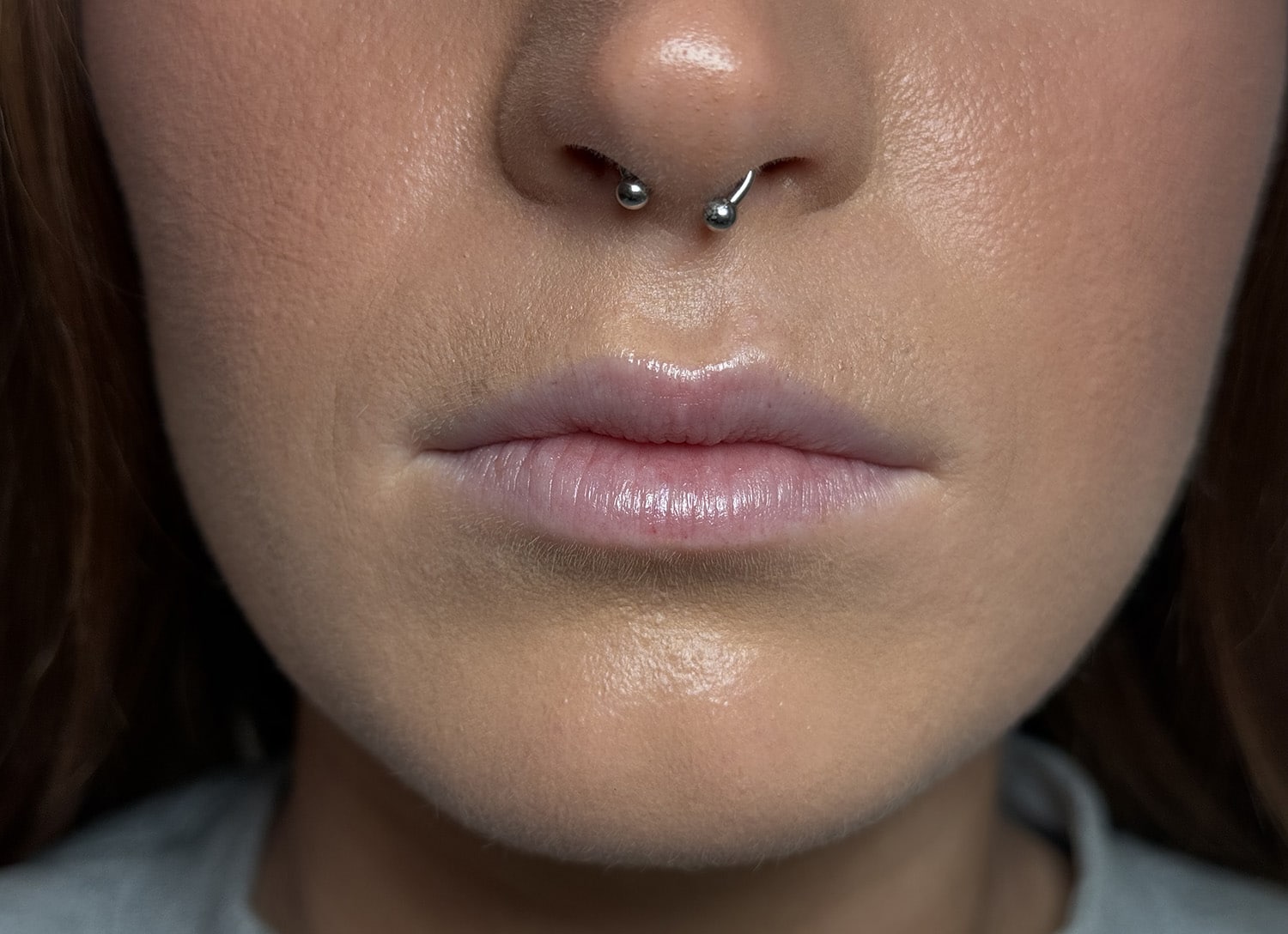 Before Image: Lip Filler - front