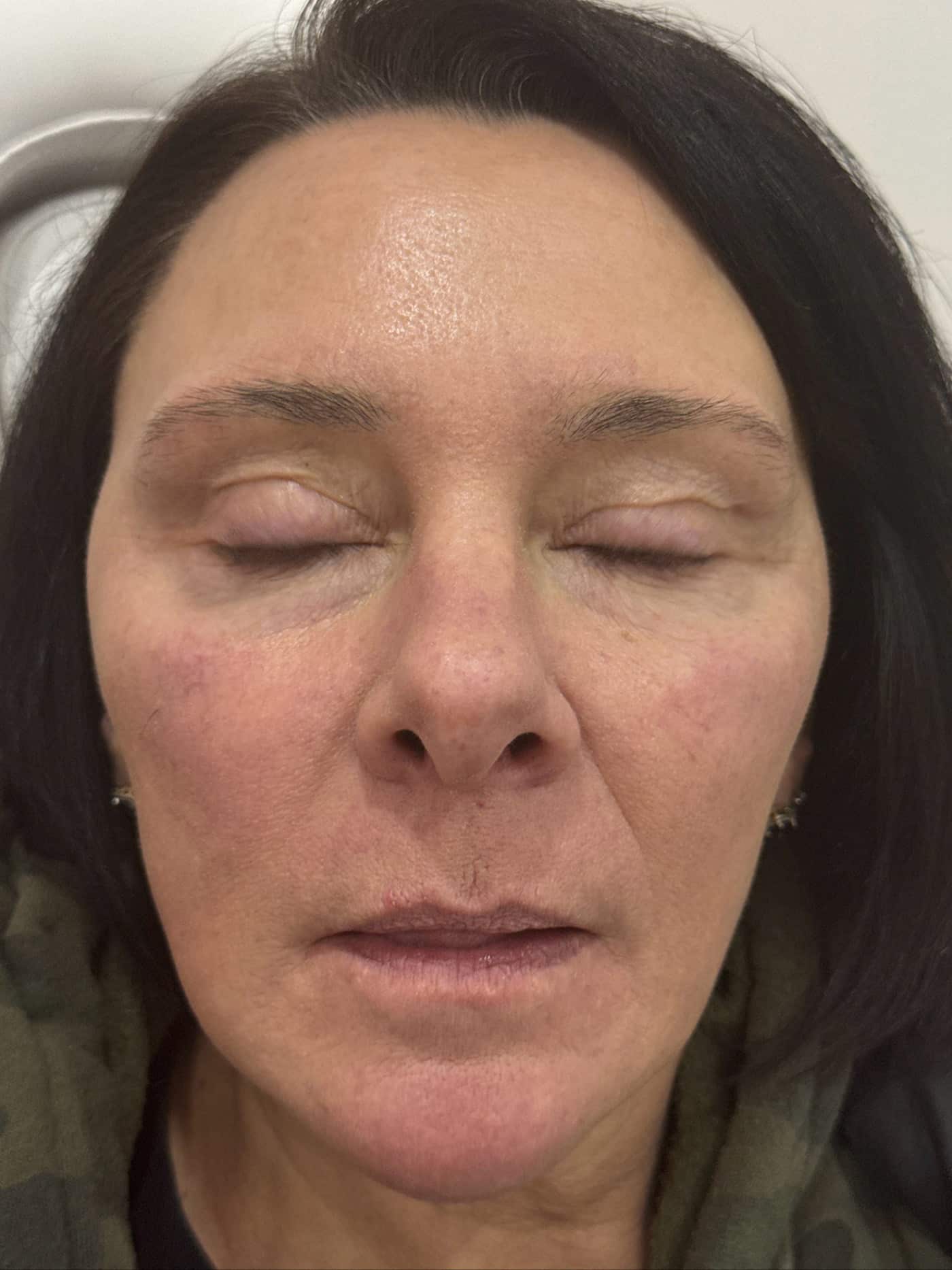 After Image: IPL for Rosacea - front