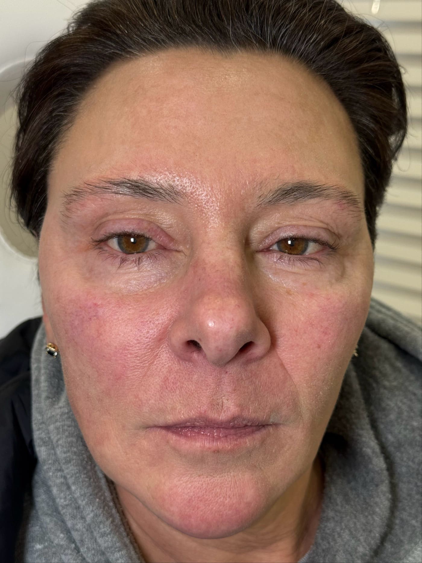 Before Image: IPL for Rosacea - front